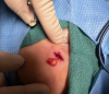 Nang bì (Dermoid Cysts)