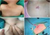 Rò phần mềm trước xương đòn
