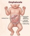 Thoát vị rốn (Omphalocele)