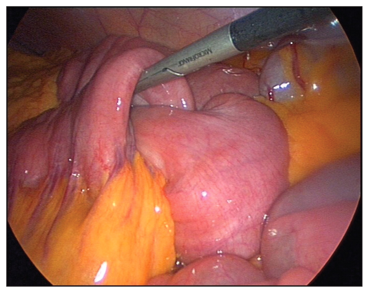 điều trị lồng ruột ở trẻ em