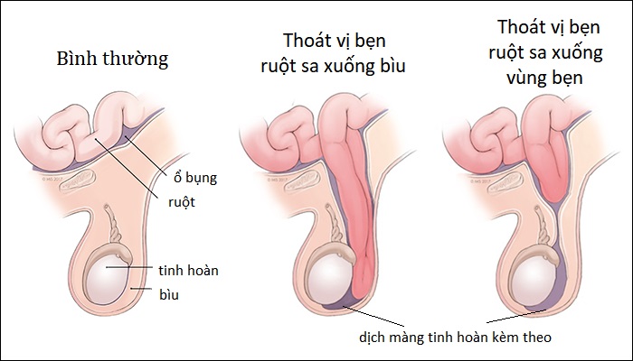 Thoát vị bẹn trẻ em