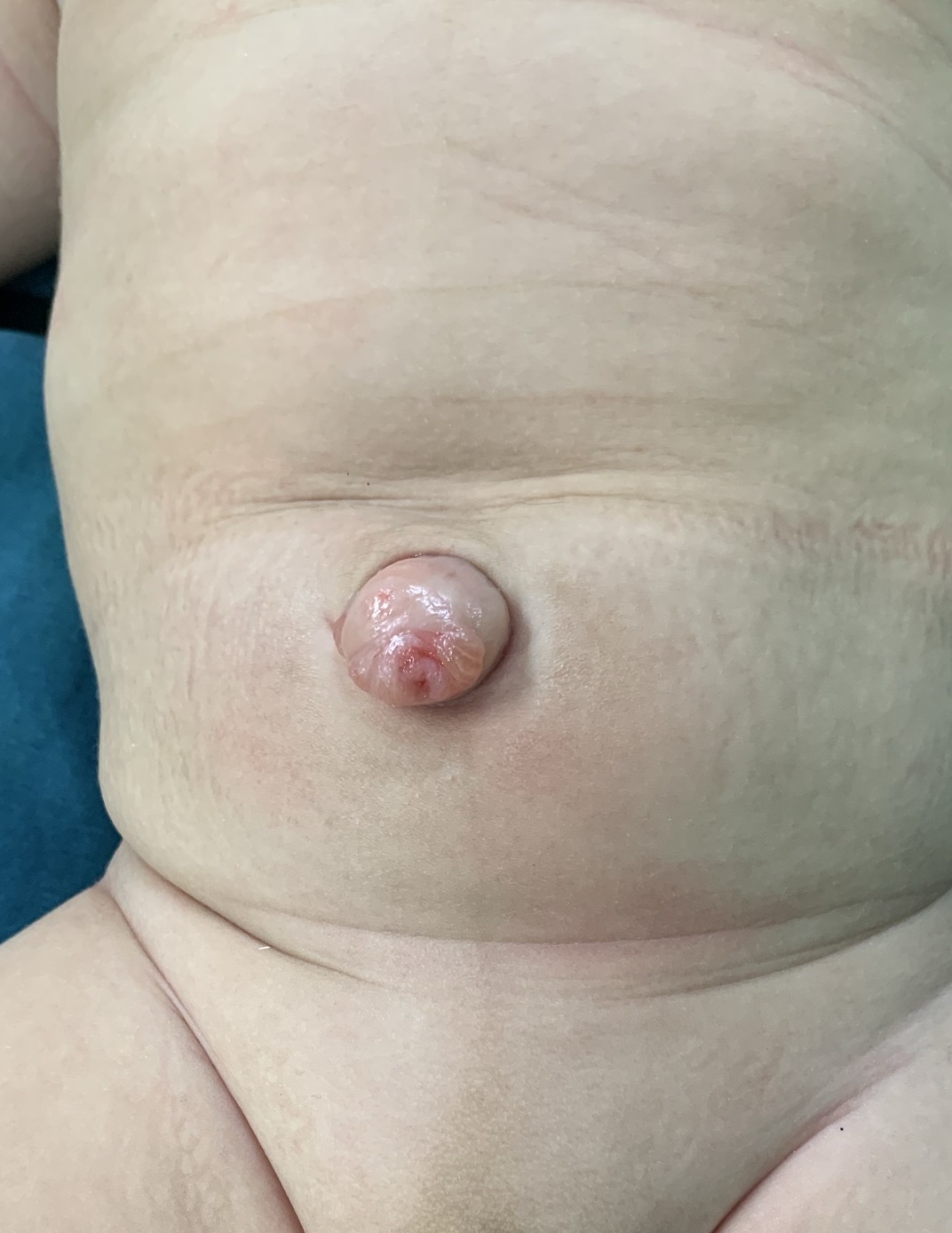 Dị tật bẩm sinh vùng rốn 