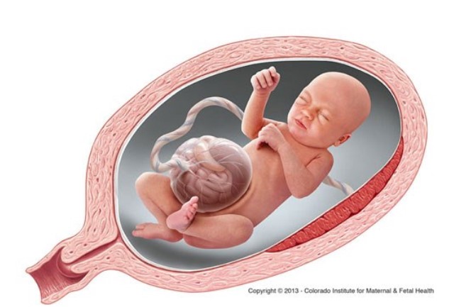 Thoát vị thành bụng sơ sinh