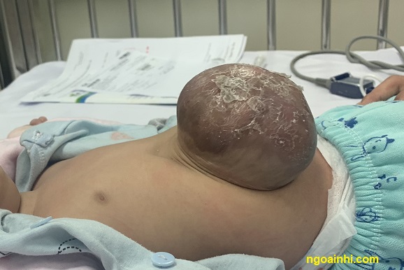 thoat vi ron so sinh