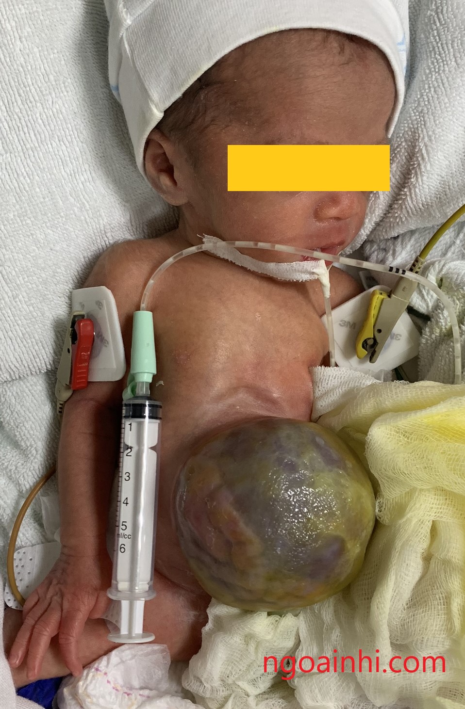 Thoát vị thành bụng 2