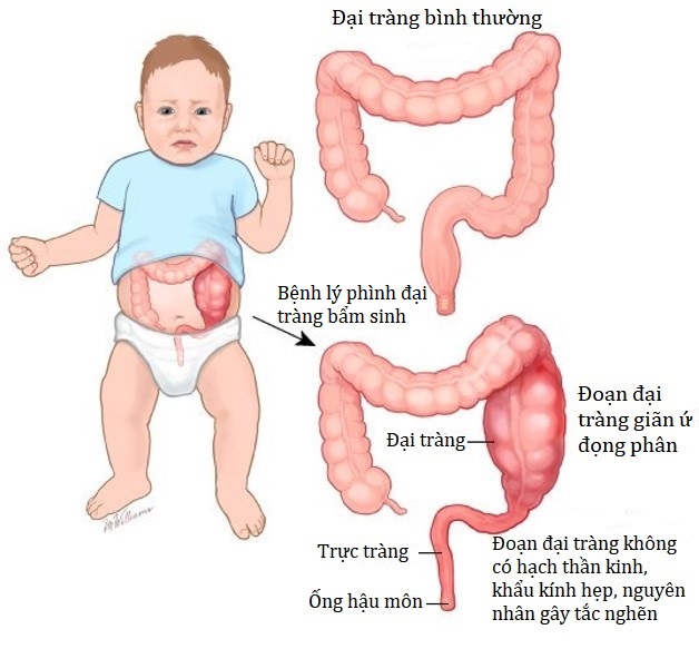 Đặc điểm bệnh lý phình đại tràng bẩm sinh