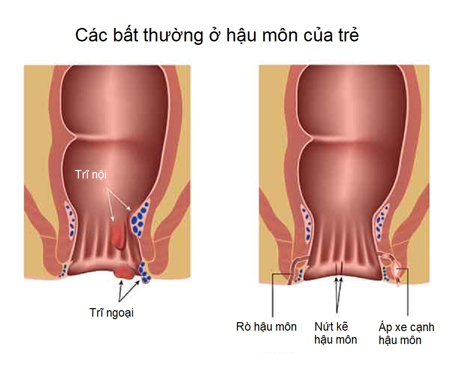 ro hau mon o tre em