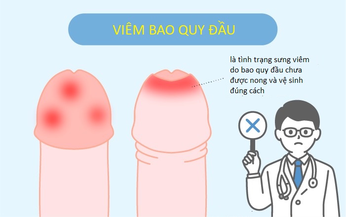Viêm bao quy đầu ở trẻ em