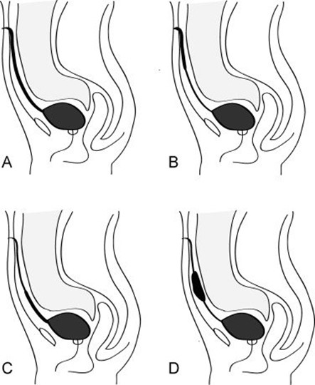 bat thuong ron tre em 2