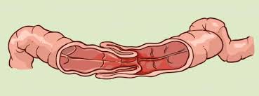 Lồng ruột ở trẻ em