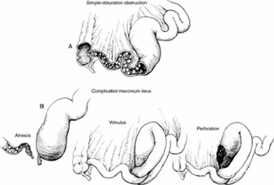 Tắc ruột phân su