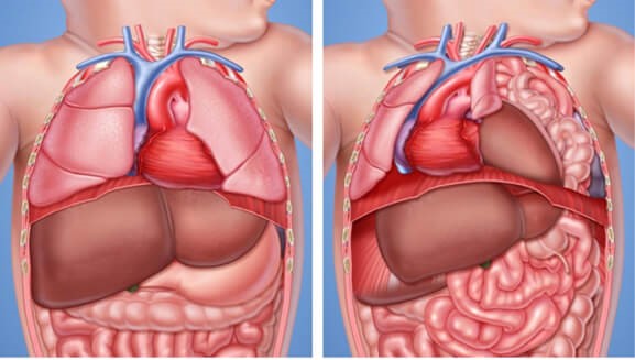 Thoát vị hoành bẩm sinh