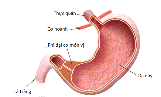 Hẹp phì đại cơ môn vị