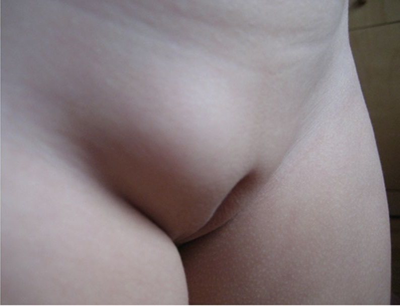 thoát vị bẹn trẻ nữ