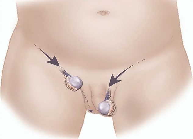 tinh hoan an o tre em