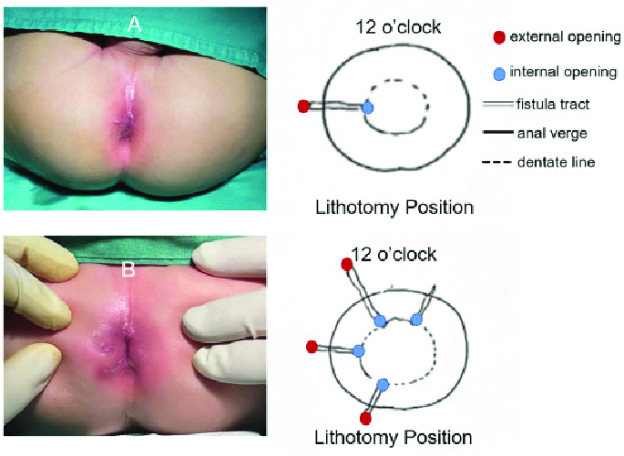 Áp xe cạnh hậu môn và rò hậu môn ở trẻ em: Những điều bố mẹ cần biết