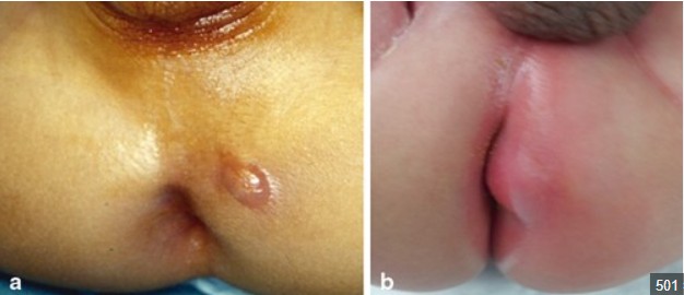 áp xe cạnh hậu môn