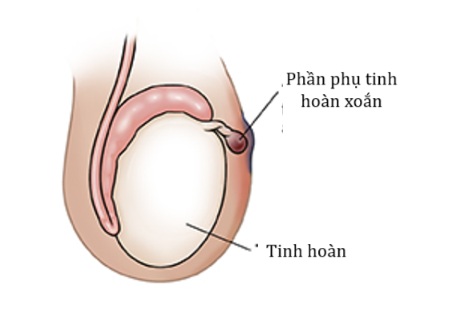 Xoắn phần phụ tinh hoàn