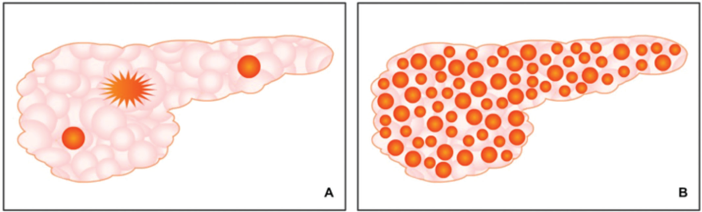 cuong insulin bẩm sinh 2