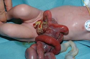 Gastroschisis 2